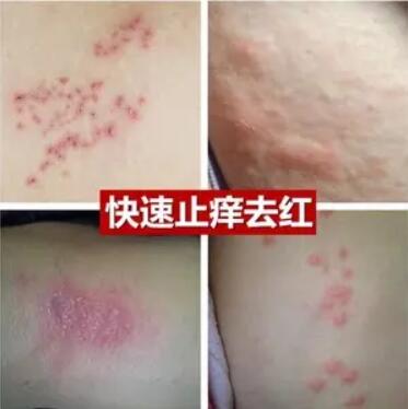 皮肤骚痒起小红疙瘩